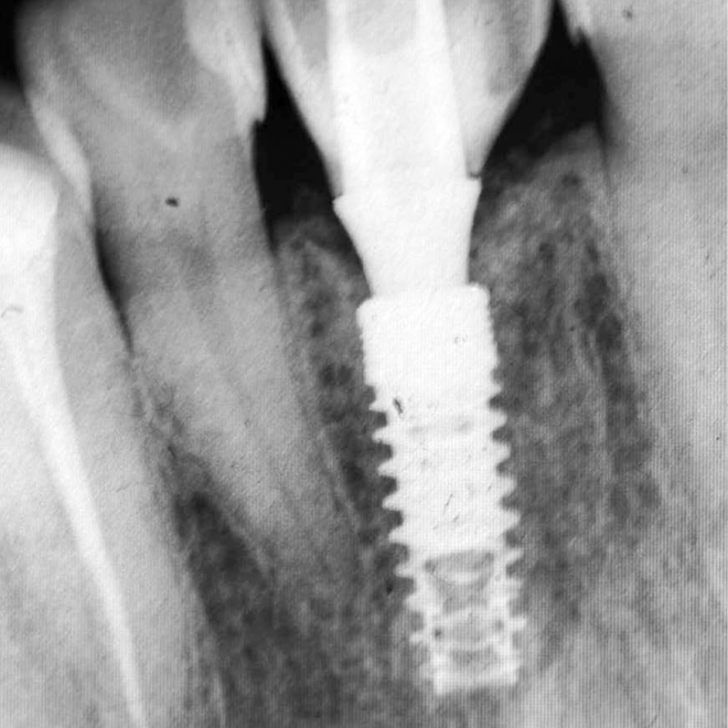 Linha Implantes 39 53_2019 Caso Clinico_FINAL 12 RAIOX
