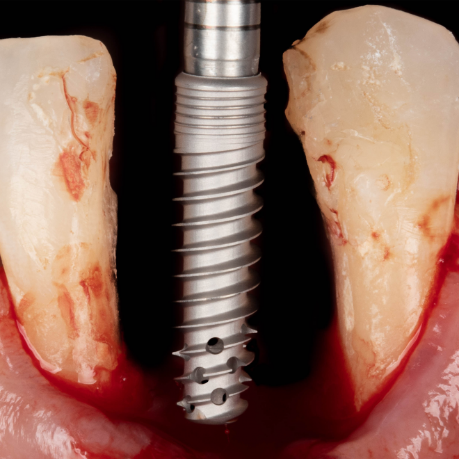 Linha Implantes 38 IMG_0469