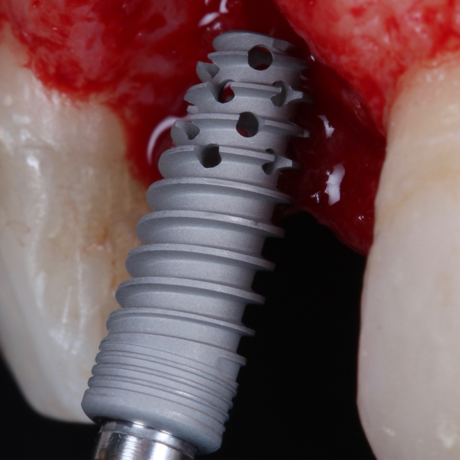 Linha Implantes 36 IMG_0813